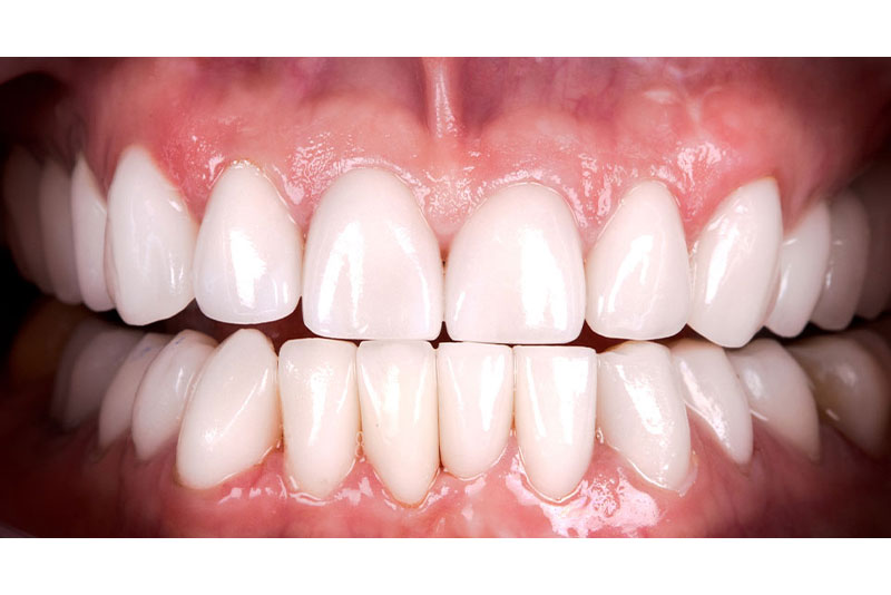 Dentist in Kingsburg CA, Dental Implants and Cosmetic Dentistry 93631 | Before & After Photos