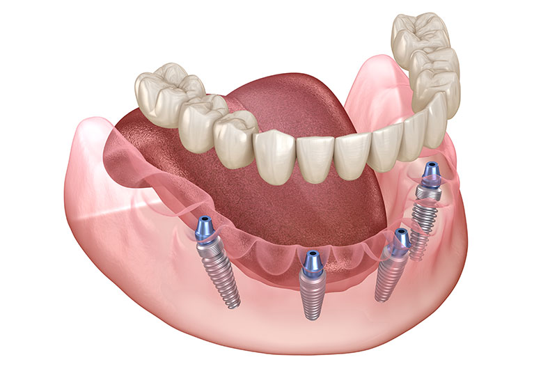 Dentist in Kingsburg CA, Dental Implants and Cosmetic Dentistry 93631|All on X Dental Implants