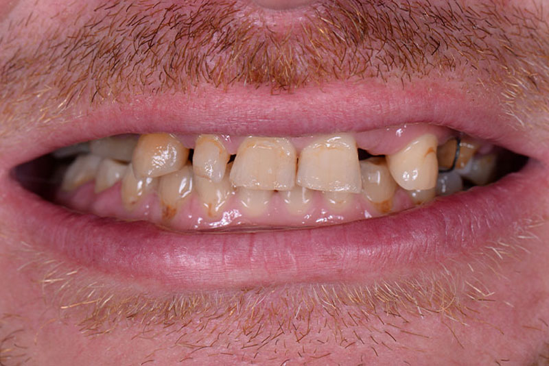 Dentist in Kingsburg CA, Dental Implants and Cosmetic Dentistry 93631 | Before & After Photos