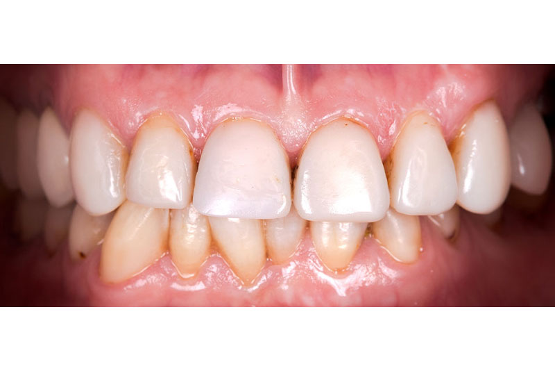 Dentist in Kingsburg CA, Dental Implants and Cosmetic Dentistry 93631 | Before & After Photos