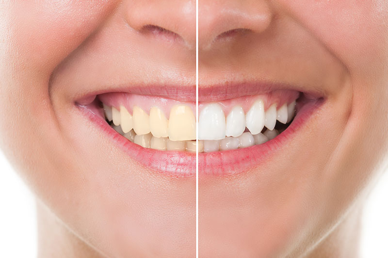 Dentist in Kingsburg CA, Dental Implants and Cosmetic Dentistry 93631|Teeth Whitening / Cleaning