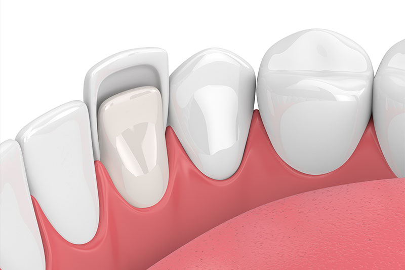 Dentist in Kingsburg CA, Dental Implants and Cosmetic Dentistry 93631|Lumineers
